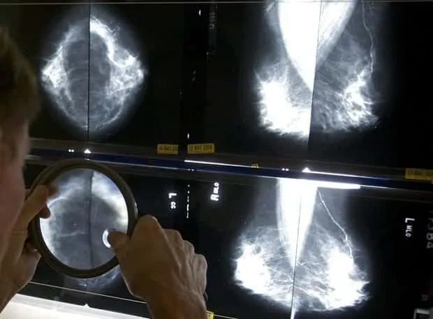 14 myths and truths about breast cancer