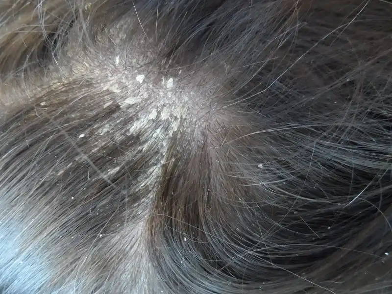 6 ways to get rid of dandruff once and for all