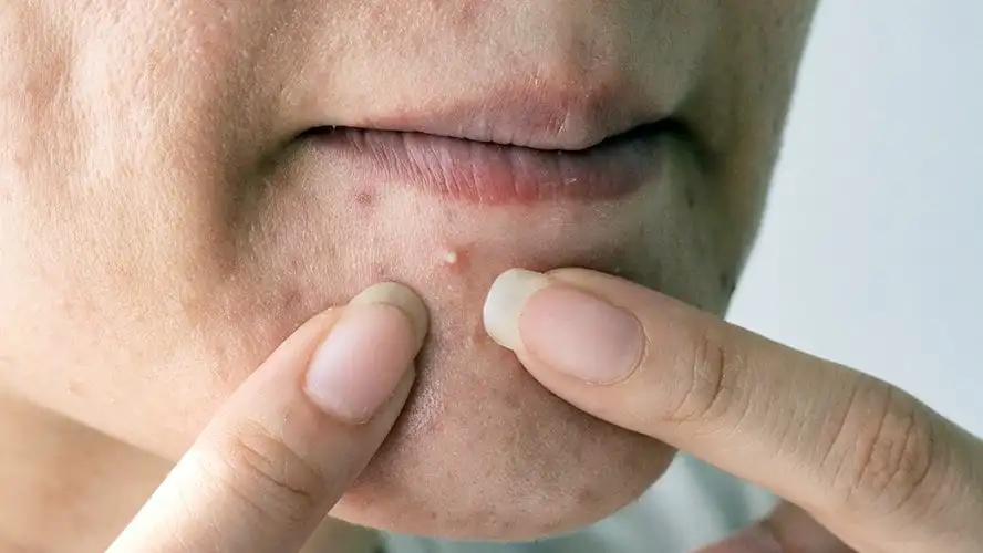 Learn how to squeeze pimples without damaging your skin