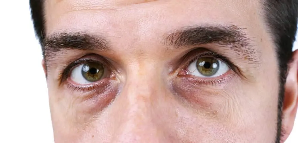 Dark circles under your eyes, what are the causes and treatments for the problem