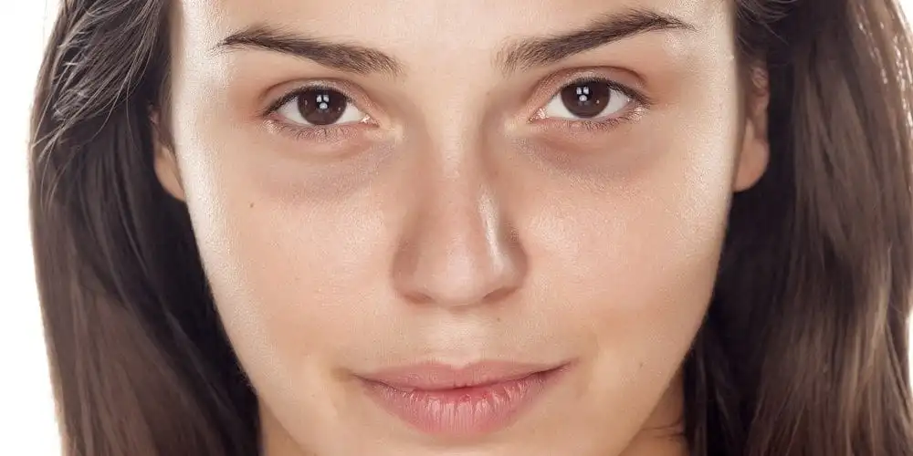 Dark circles under your eyes, what are the causes and treatments for the problem