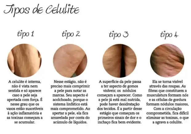 Cellulite, 7 tips to eliminate it from your body once and for all