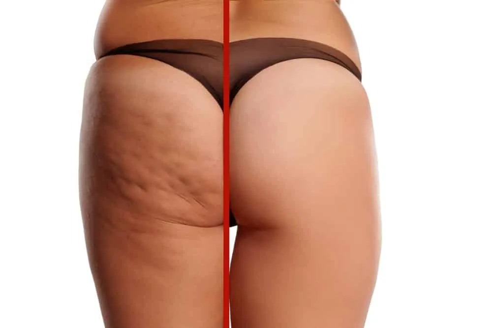 Cellulite, 7 tips to eliminate it from your body once and for all