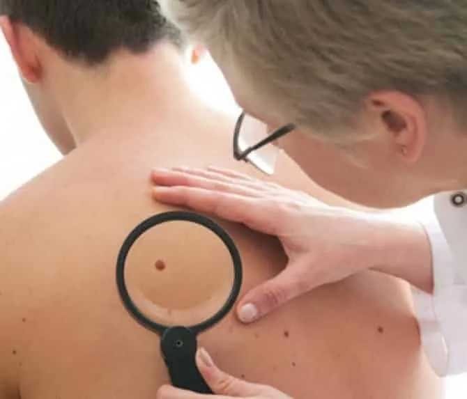 Be aware of skin cancer and know when it's time to see a doctor