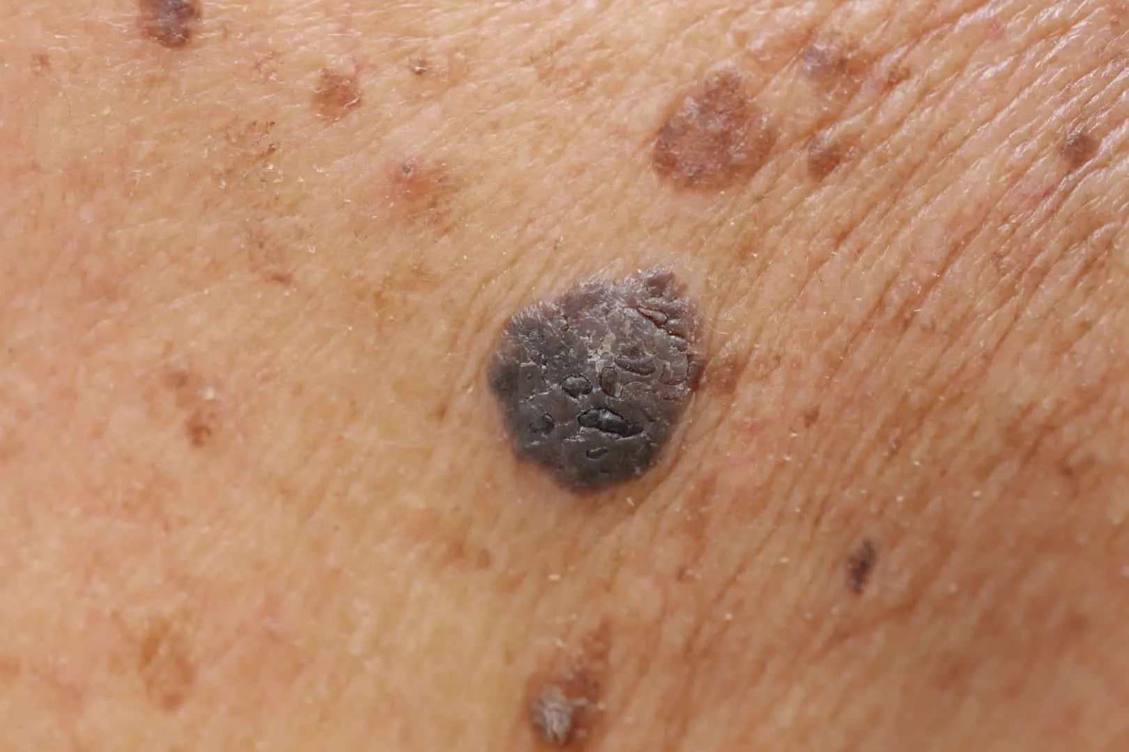 Be aware of skin cancer and know when it's time to see a doctor