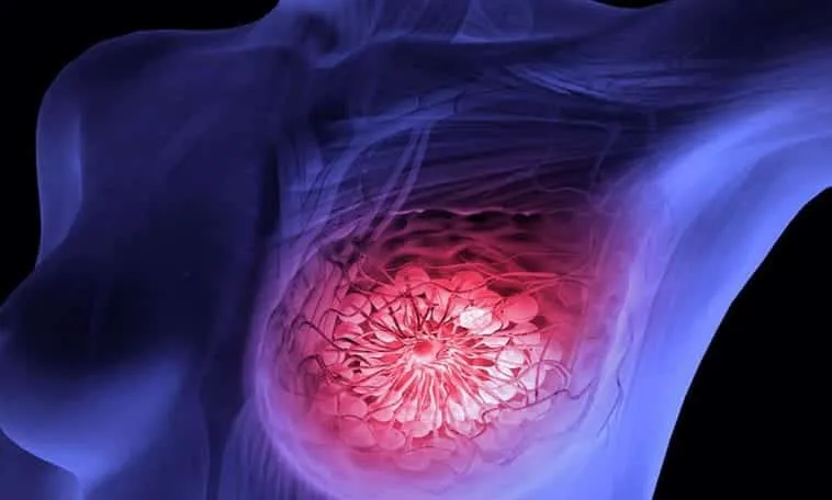 Breast cancer, all about the most common disease among women in the world