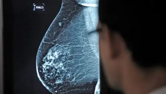 Breast cancer, all about the most common disease among women in the world