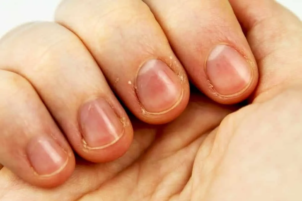 What are the causes and possible treatments for peeling nails?