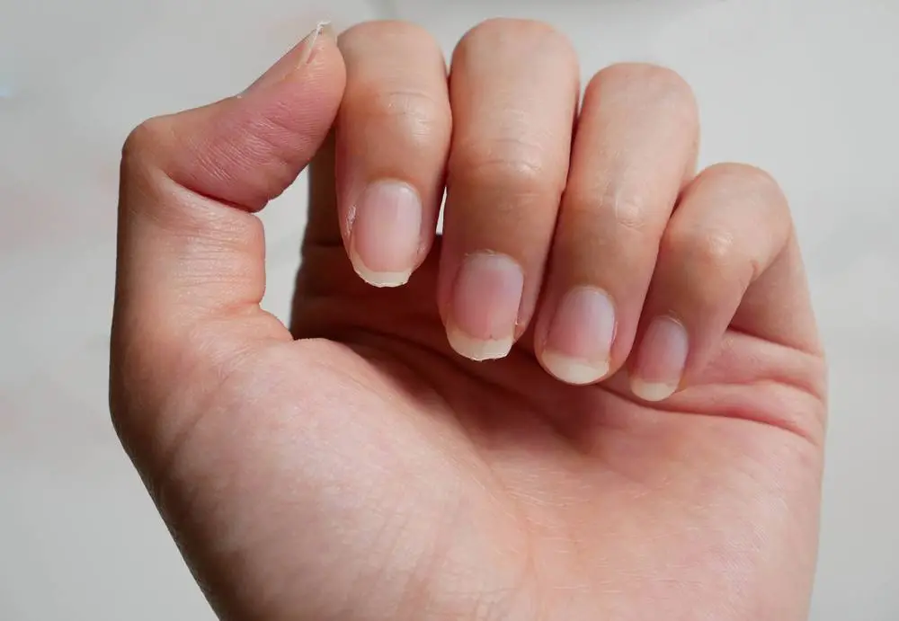 What are the causes and possible treatments for peeling nails?