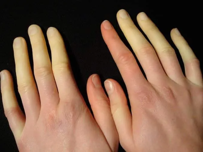 Raynaud's disease mainly affects women and too much cold can be a symptom