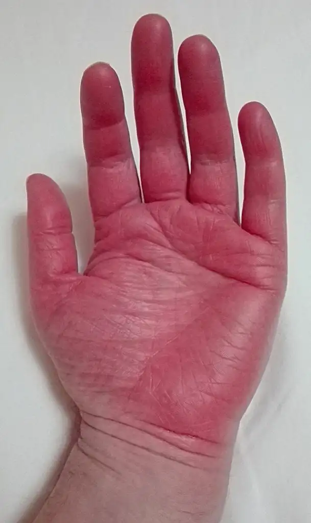 Raynaud's disease mainly affects women and too much cold can be a symptom