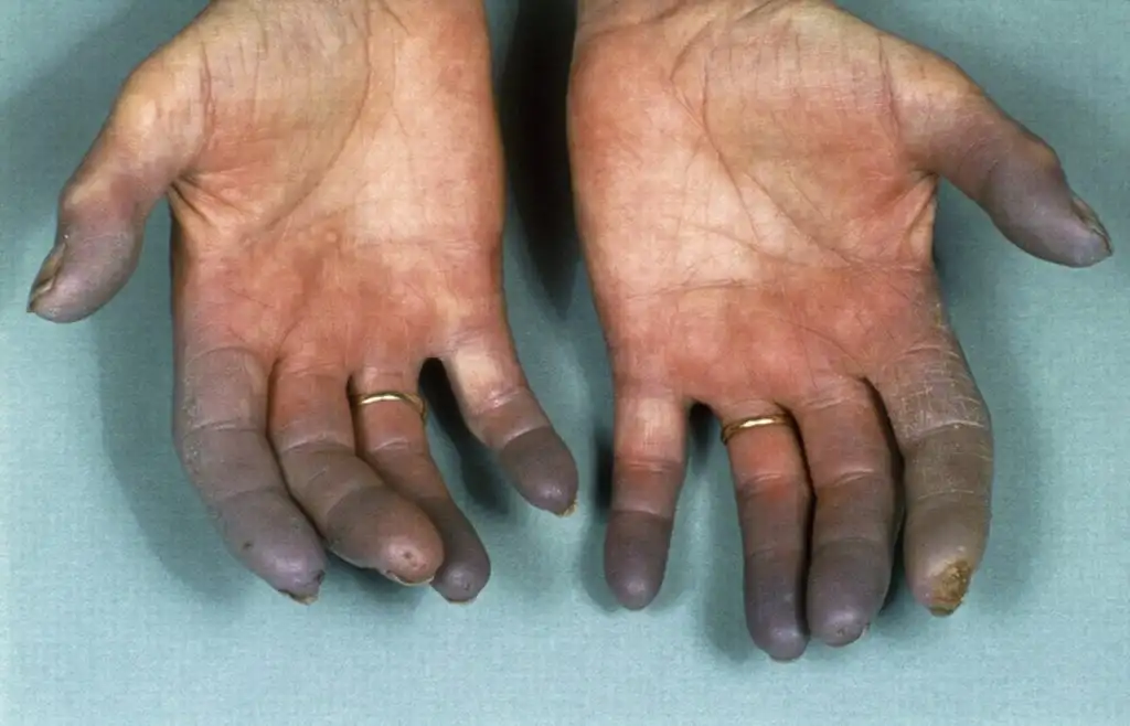 Raynaud's disease mainly affects women and too much cold can be a symptom