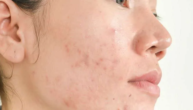 Savon acné, comment choisir celui idéal ?  12 meilleurs produits