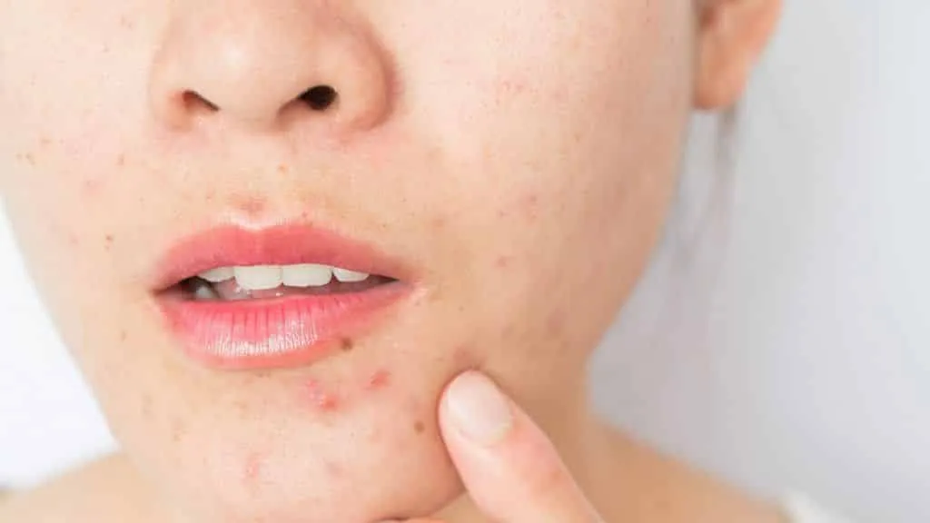 Hormonal diseases cause pimples