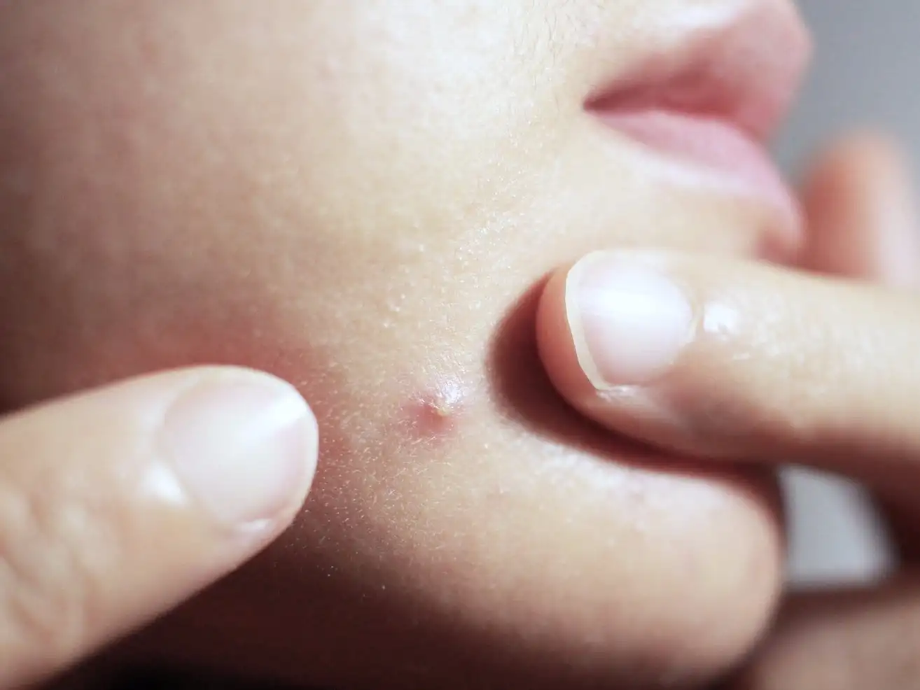 Pimples on the chin - find out what they are and why they occur