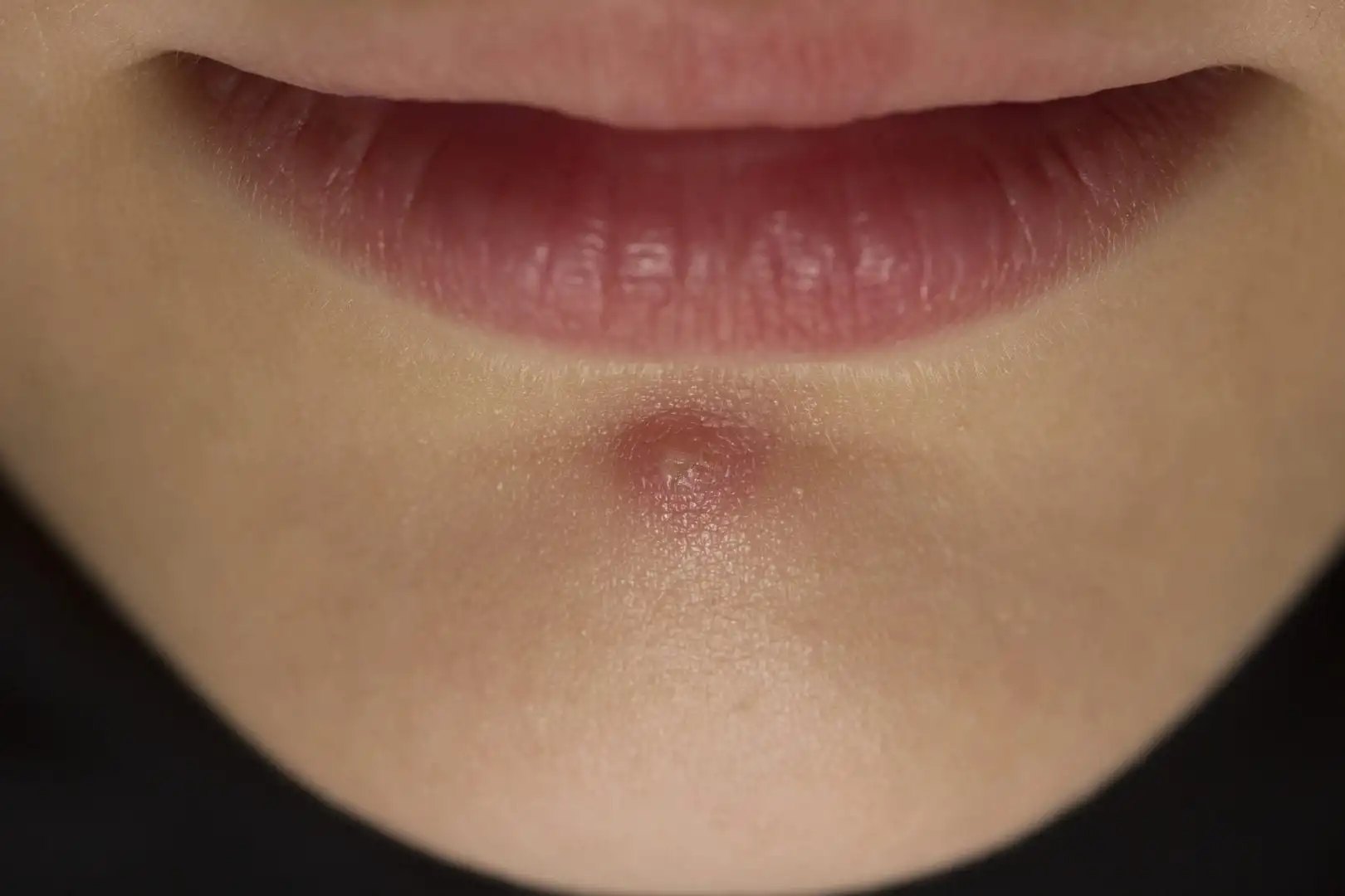 Pimples on the chin - find out what they are and why they occur