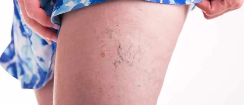 Cream for varicose veins - what it is, how they appear and treatments