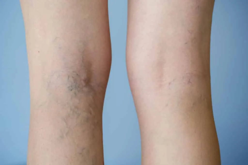 Cream for varicose veins - what it is, how they appear and treatments