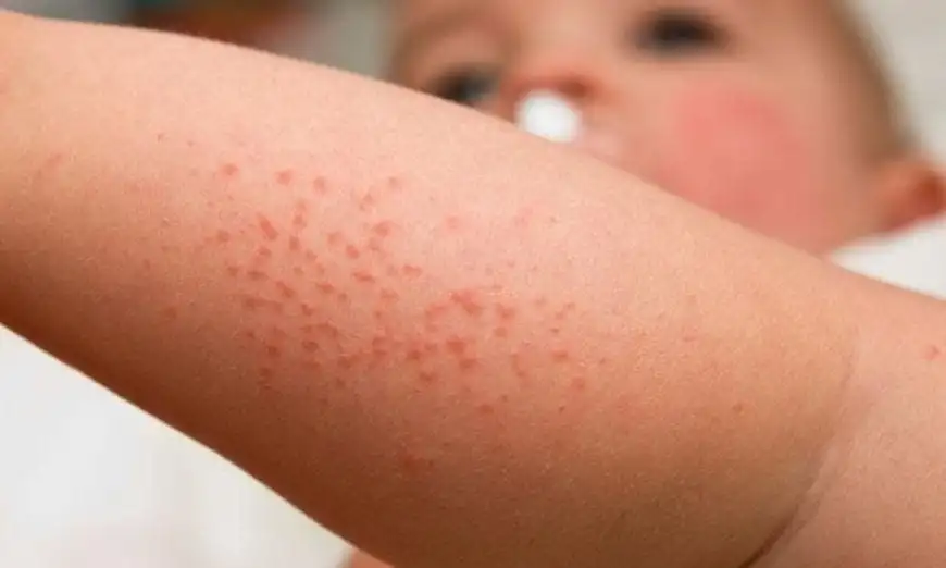 Dermatitis - what it is, symptoms, types of disease and how to treat it