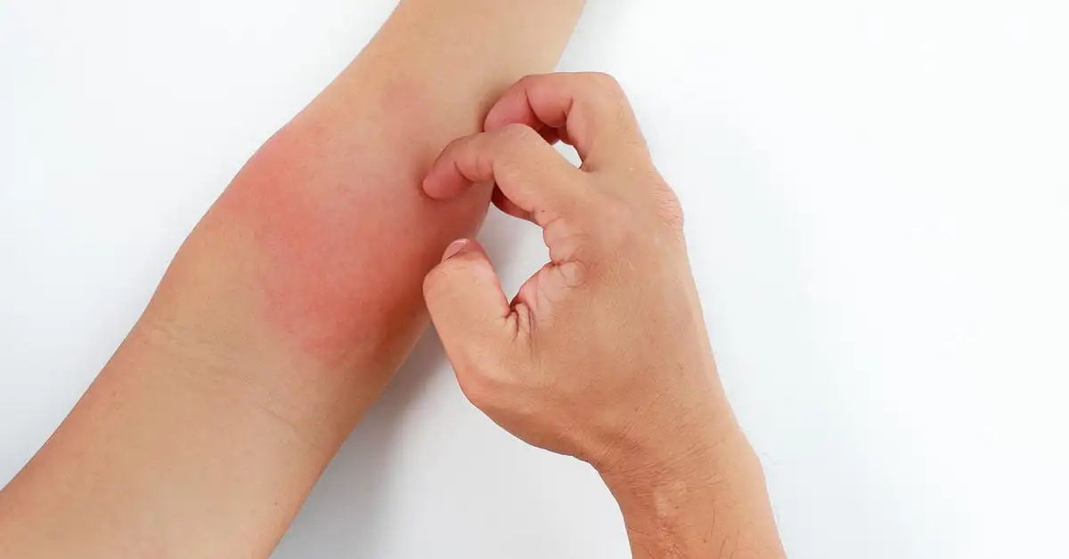 Dermatitis - what it is, symptoms, types of disease and how to treat it