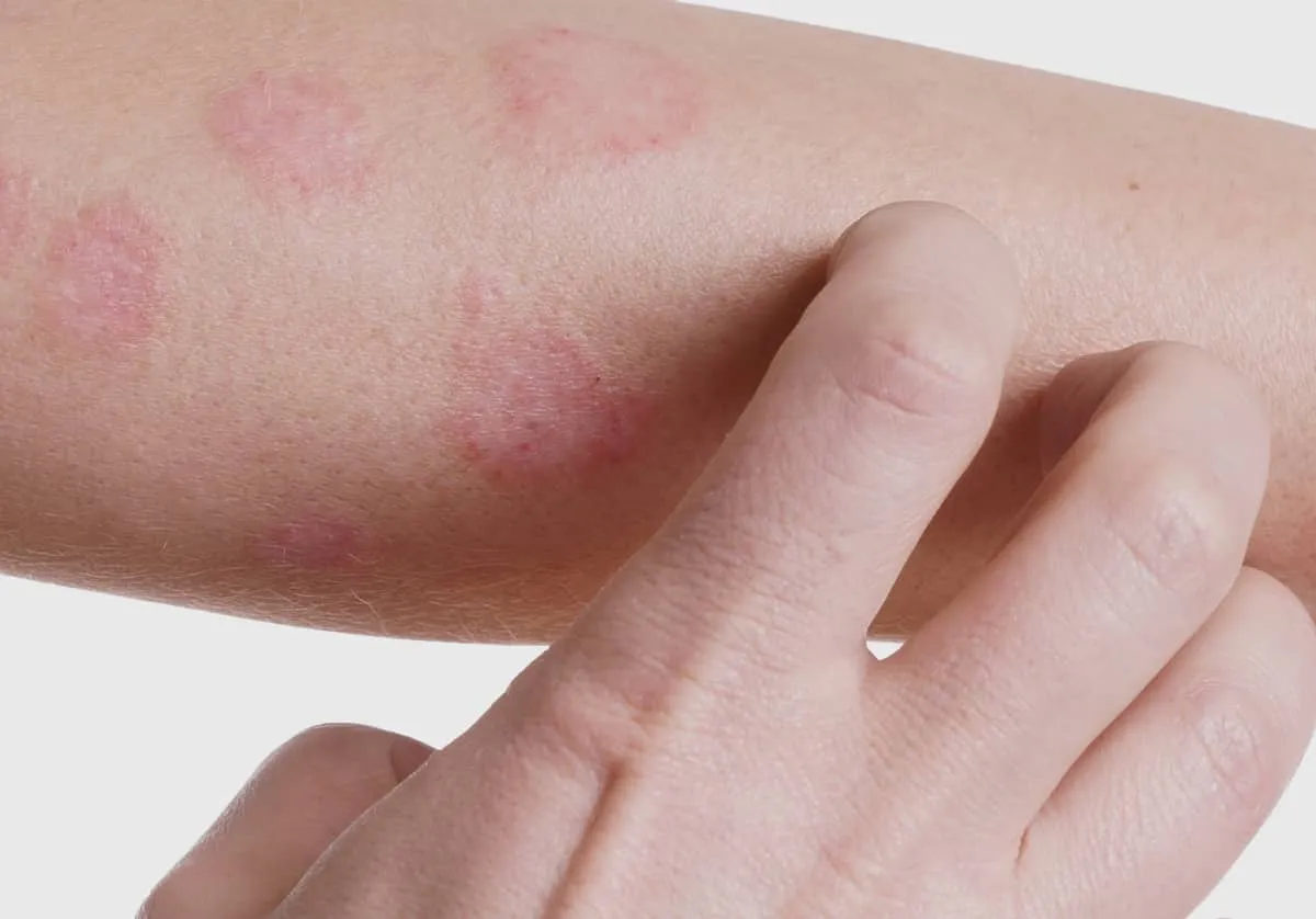 Dermatitis - what it is, symptoms, types of disease and how to treat it