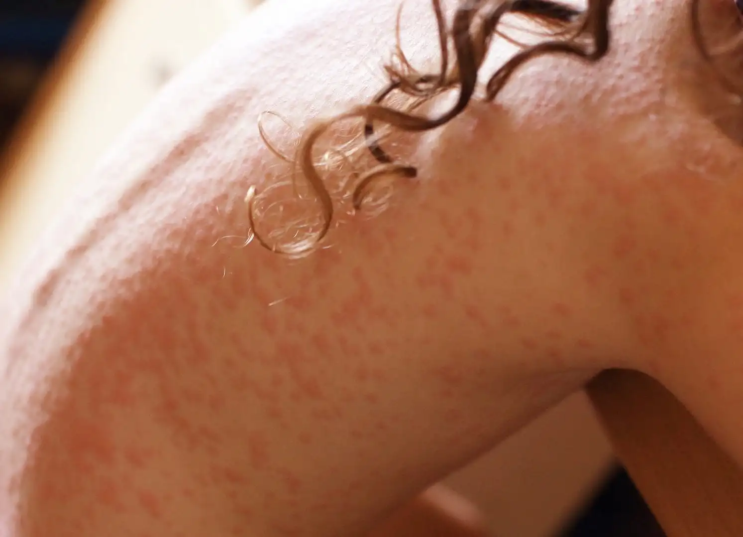 Dermatitis - what it is, symptoms, types of disease and how to treat it