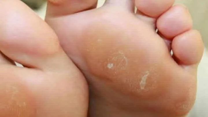 Calluses on the feet - what are they, how to prevent them and what are the treatments