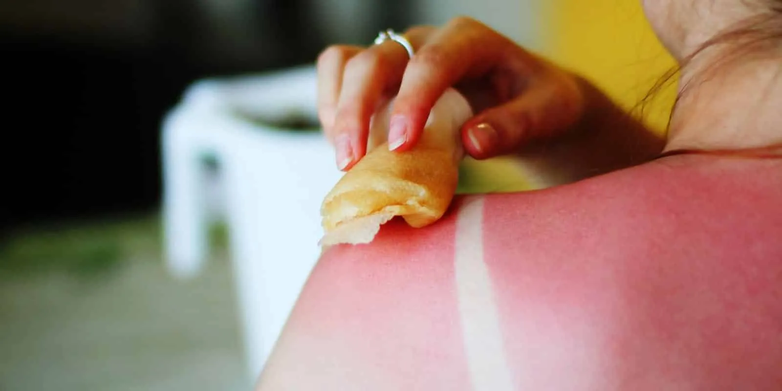 Sunburn - what it causes on the skin, how to avoid it and treatments