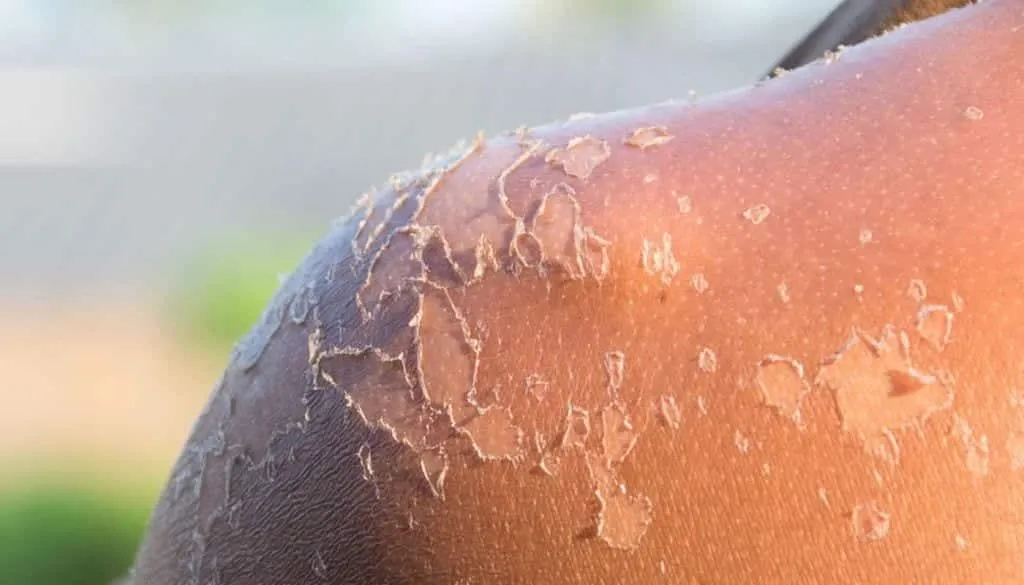 Sunburn - what it causes on the skin, how to avoid it and treatments