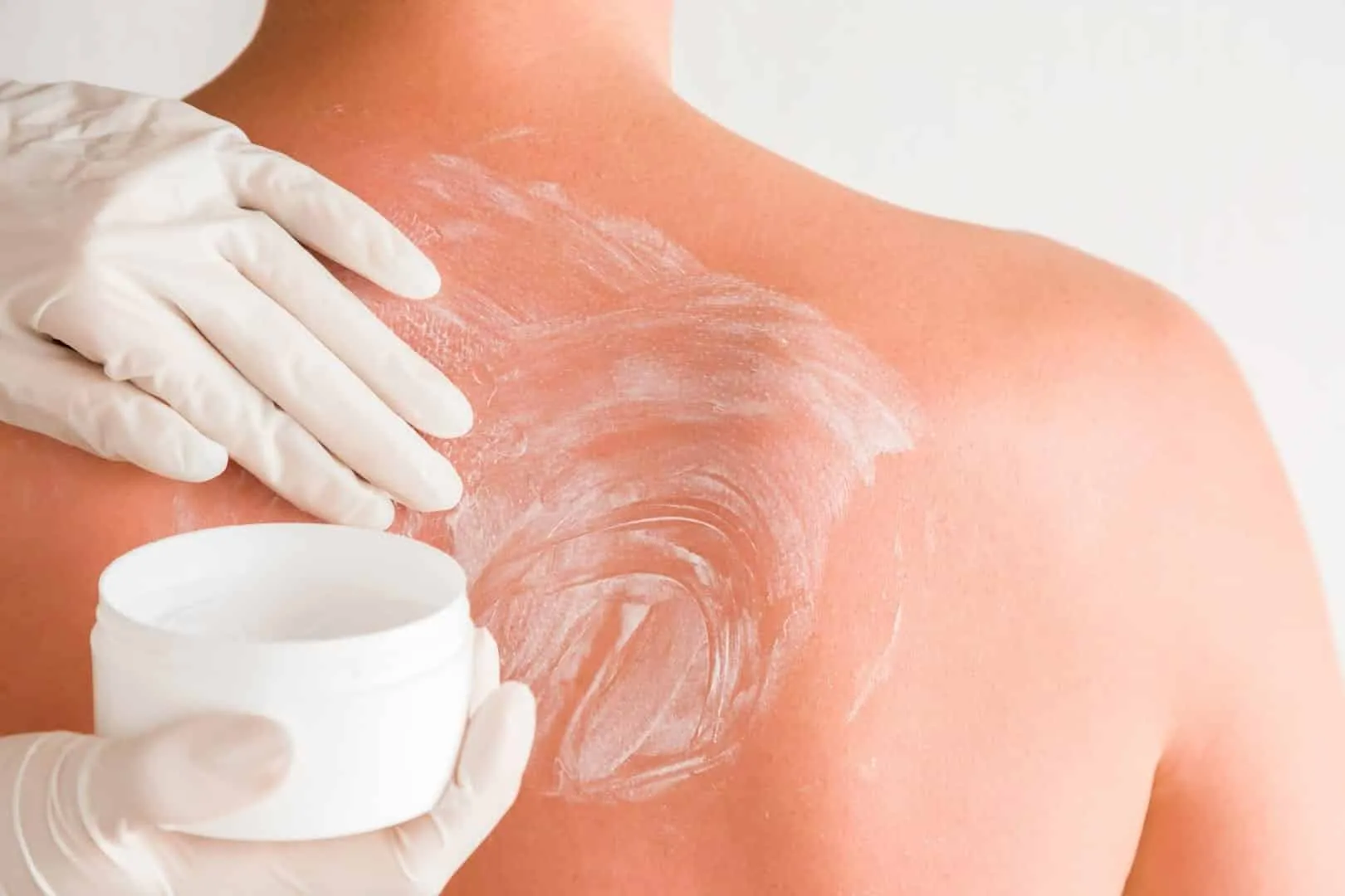 Sunburn - what it causes on the skin, how to avoid it and treatments