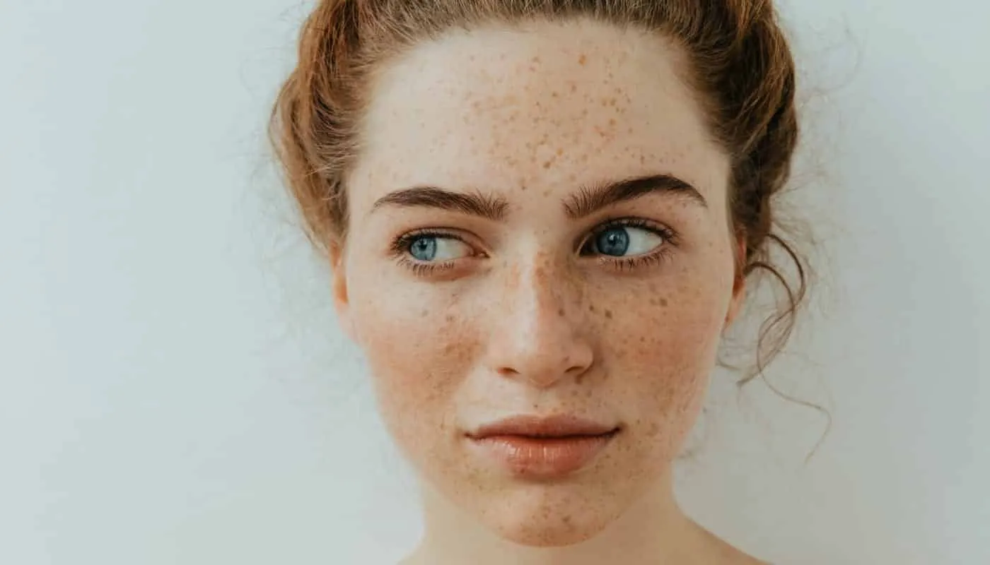 Dark spots on the skin: What they are, types and treatments