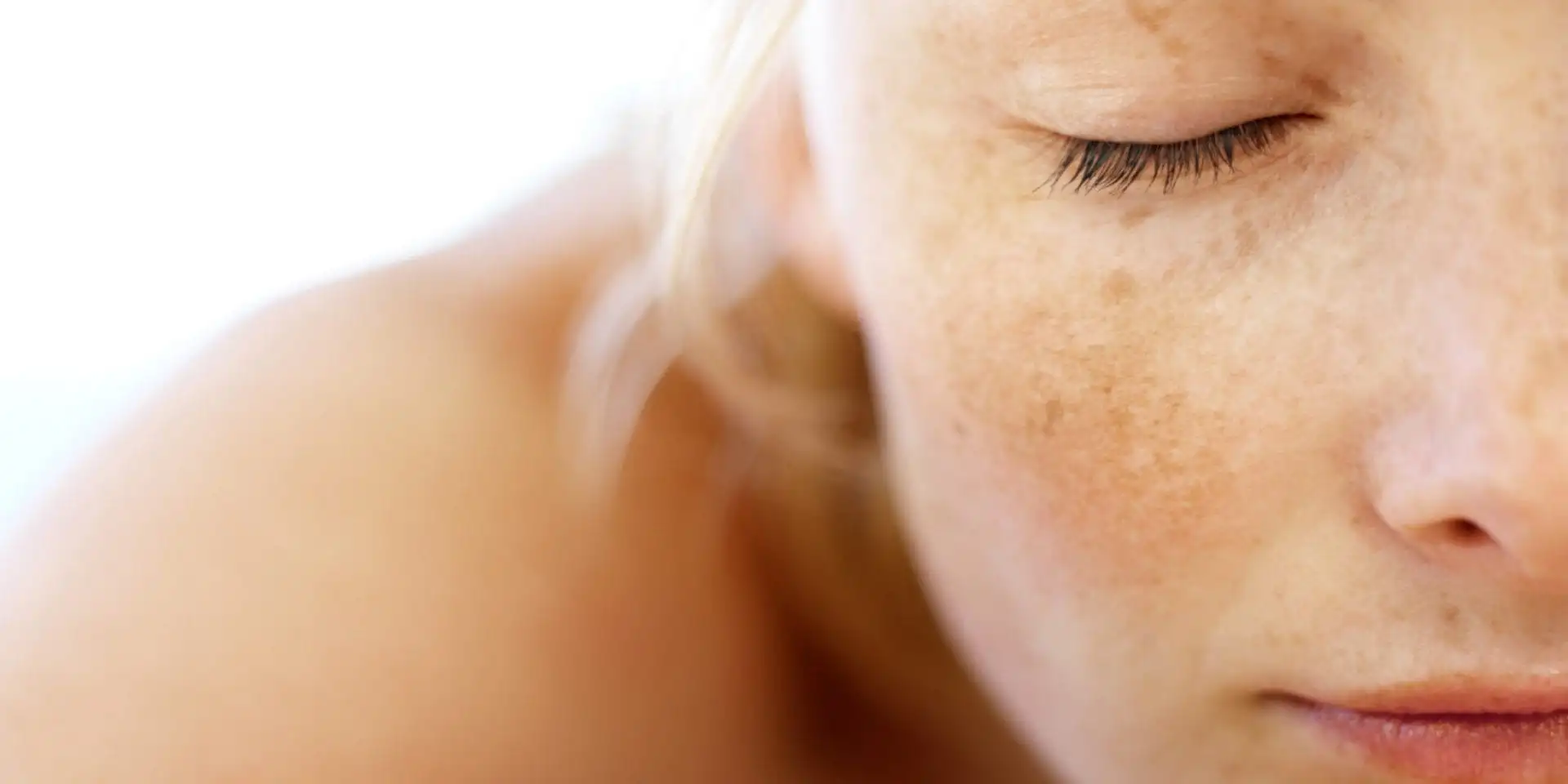 Dark spots on the skin: What they are, types and treatments