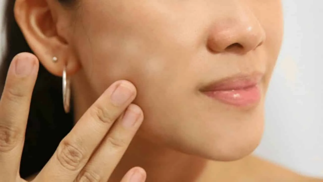 Dark spots on the skin: What they are, types and treatments