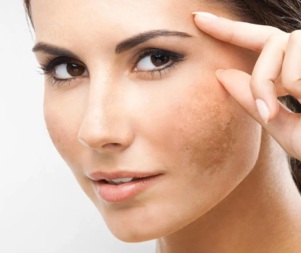 Dark spots on the skin: What they are, types and treatments