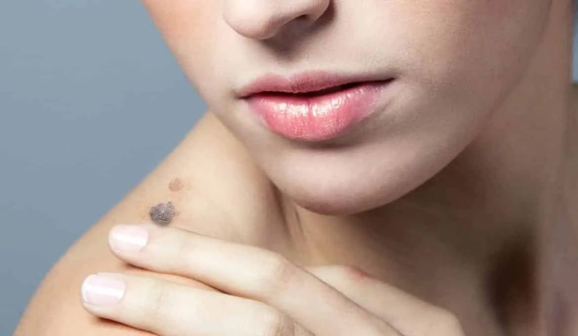 Dark spots on the skin: What they are, types and treatments