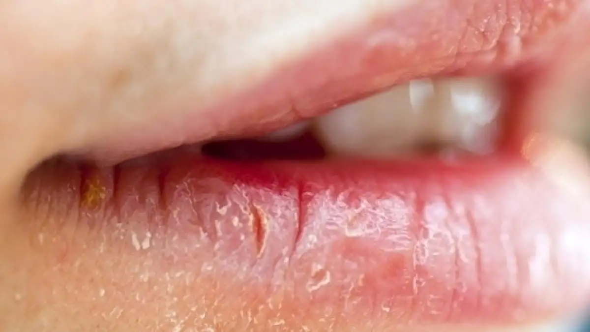 Lips that ressecam, sensitivity, and health of the lips + tips