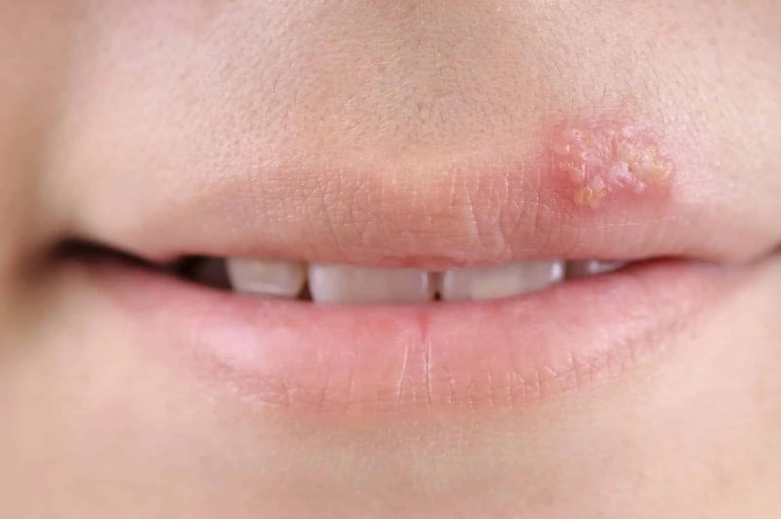 Lips that ressecam, sensitivity, and health of the lips + tips