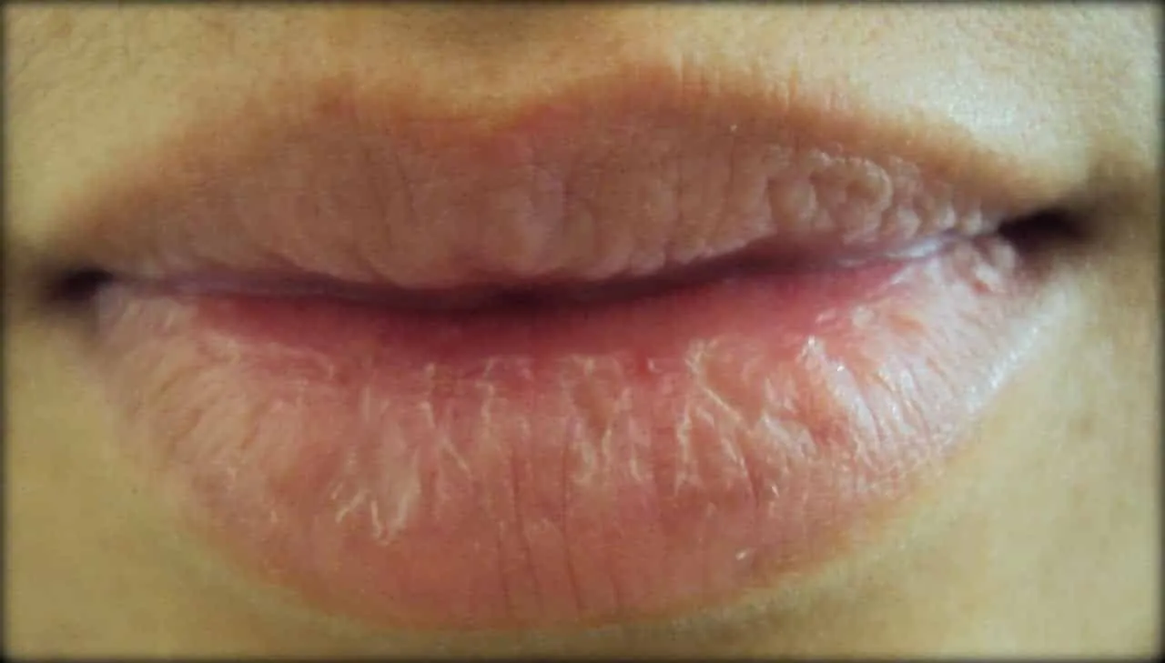 Lips that ressecam, sensitivity, and health of the lips + tips