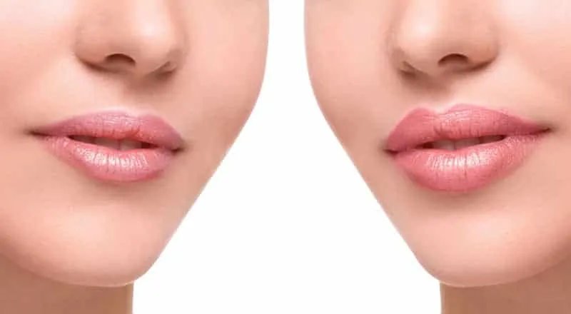 What's your lip filler, how much is a contra-indication