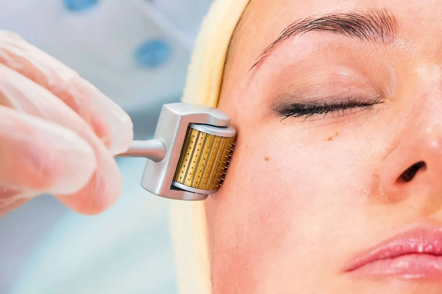 Melasma medicine - find out the best forms of treatment