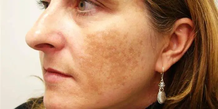 Melasma medicine - find out the best forms of treatment