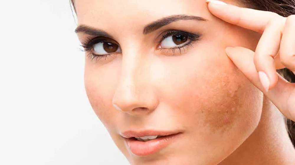 Melasma medicine - find out the best forms of treatment