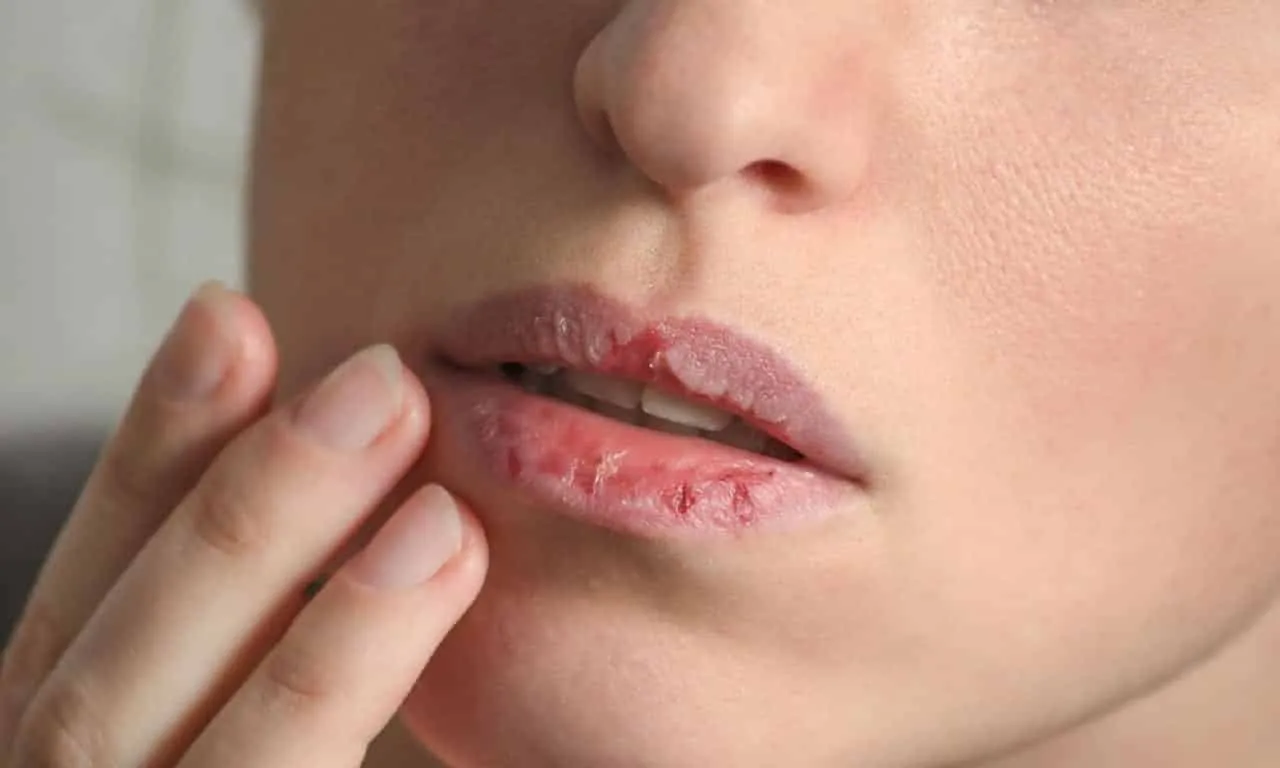 Dry lips - what causes it, how to care for it and avoid it in the future