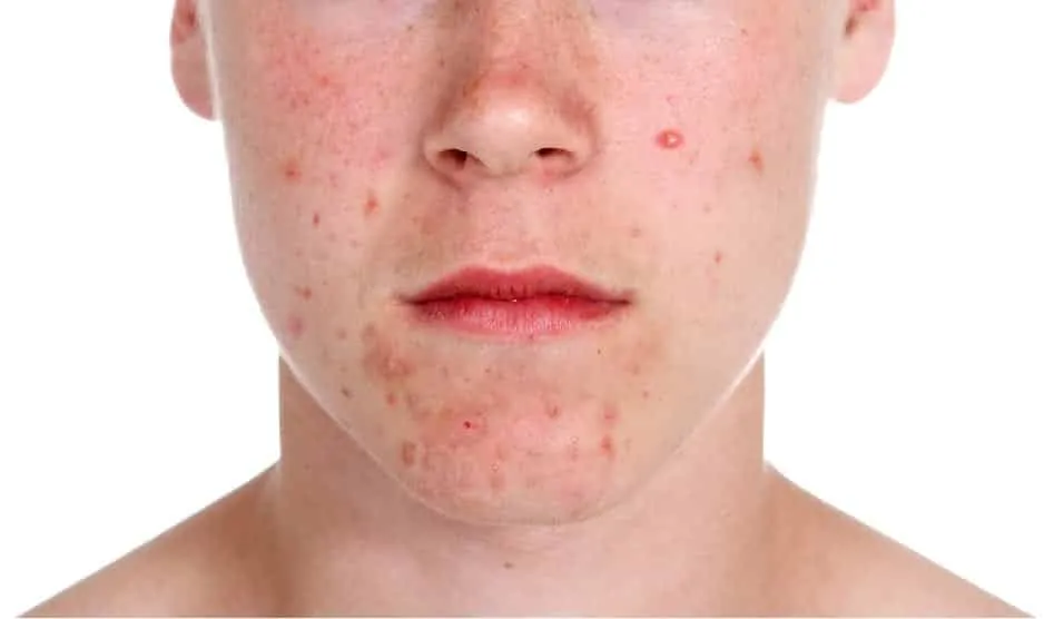 Birth control for acne?  Find out if the medicine really combats this