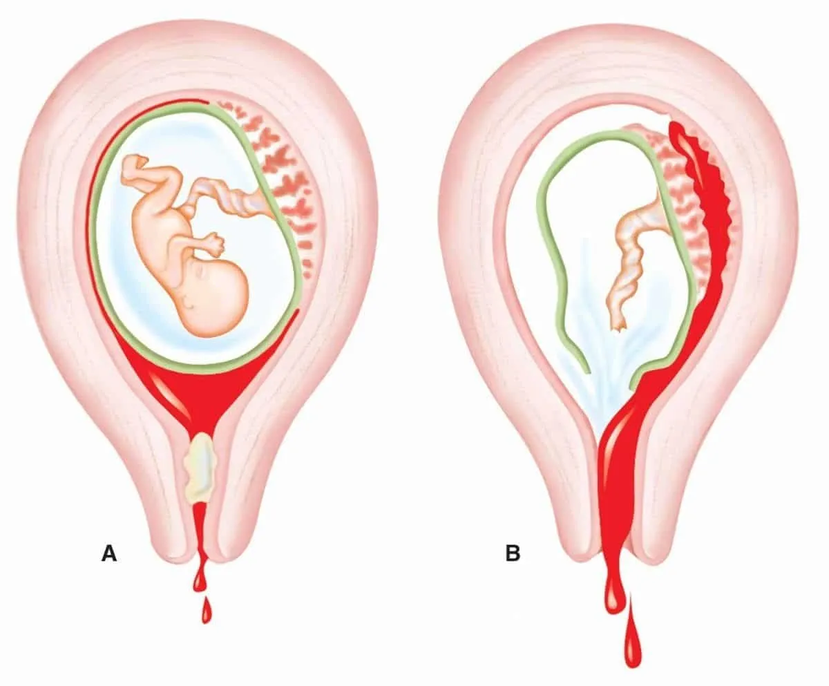 Spontaneous abortion, what it is, causes, symptoms and treatments