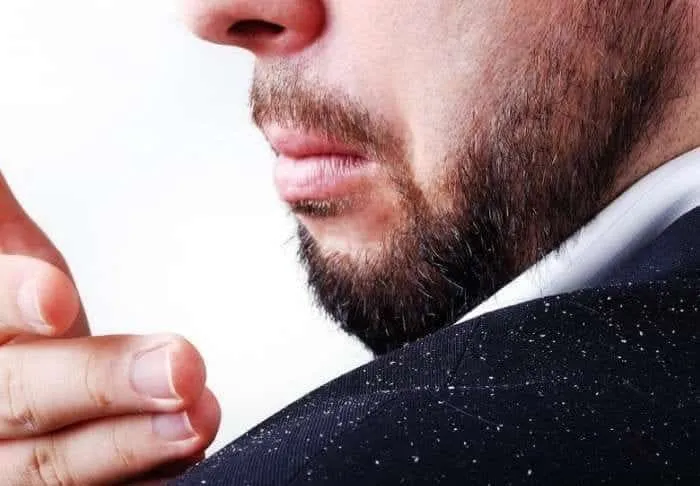 Dandruff, what is it?  Causes, symptoms, treatment and prevention