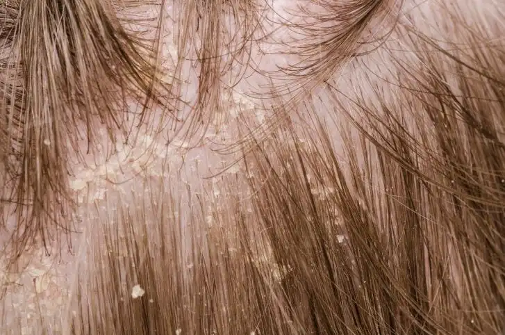 Dandruff, what is it?  Causes, symptoms, treatment and prevention