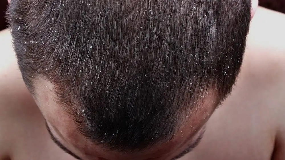 Dandruff, what is it?  Causes, symptoms, treatment and prevention