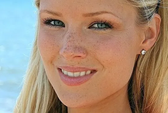 freckles