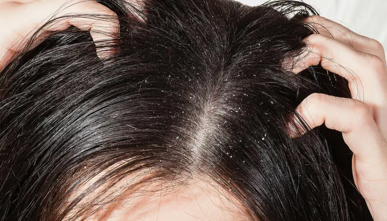 Aloe vera in hair - what it is for, benefits and how to do it